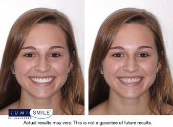 lumismile before and after